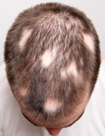 Alopecia areata - Hair Center Serbia