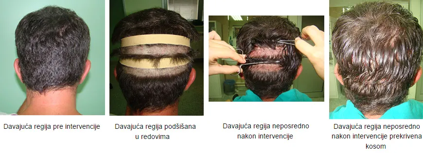 FUE tehnika bez šišanja – procedura