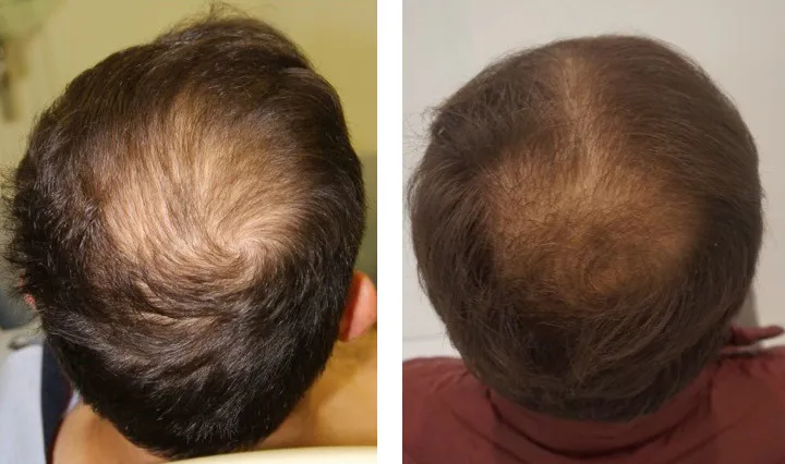 PRP tretman za poboljšanje rasta kose pre i posle