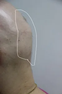 Alopecija areata - šta je najnovije?