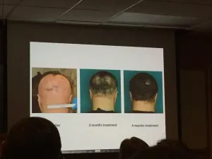 Alopecija areata - šta je najnovije?