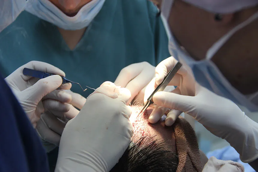 Cena transplantacije kose