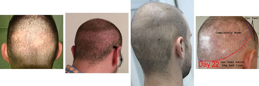 Cena transplantacije kose