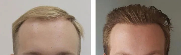 Cena transplantacije kose