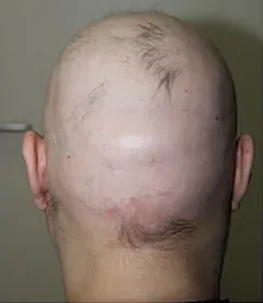 Priča o lečenju Alopecije Totalis iz ugla i pacijenta i lekara