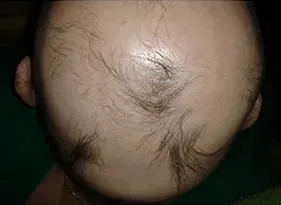 Priča o lečenju Alopecije Totalis iz ugla i pacijenta i lekara