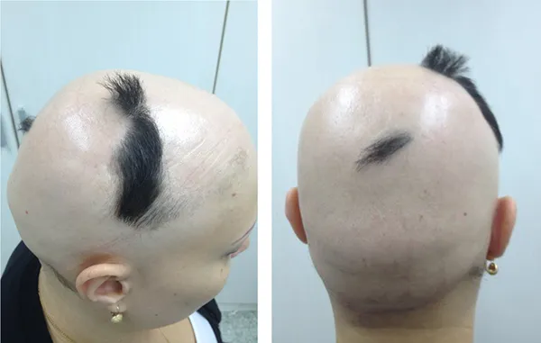 Priča o lečenju Alopecije Totalis iz ugla i pacijenta i lekara