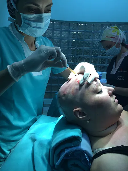 Priča o lečenju Alopecije Totalis iz ugla i pacijenta i lekara