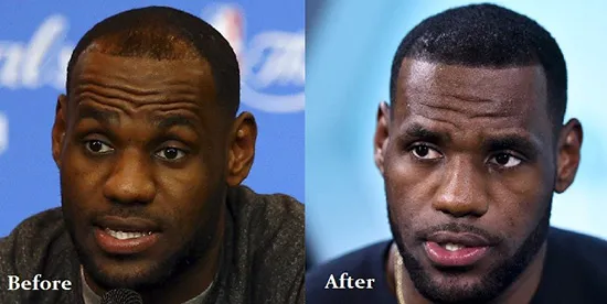 Greške u transplantaciji kose