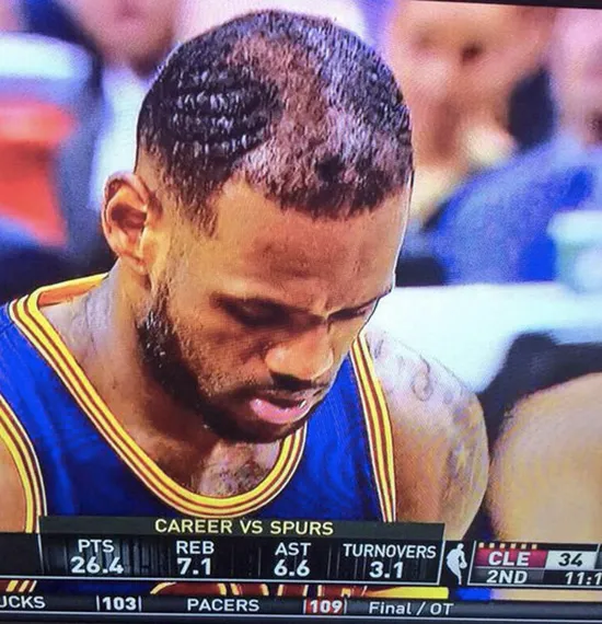 Greške u transplantaciji kose