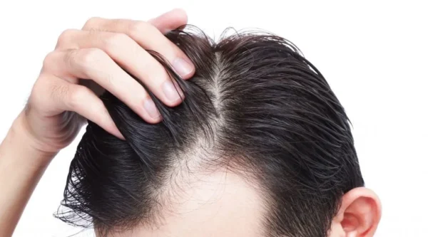 Šta ako nakon transplantacije kosa slabo raste?