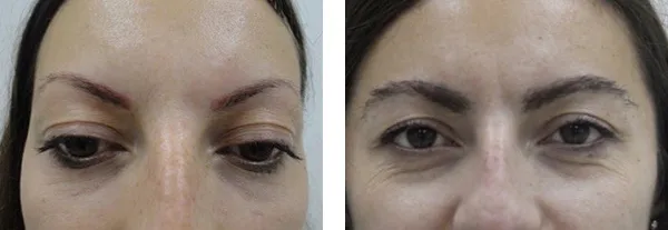 Transplantacija obrva? Pre i posle.