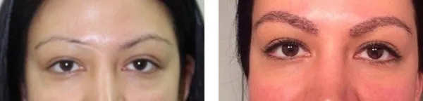 Transplantacija obrva? Pre i posle.