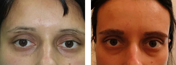 Transplantacija obrva? Pre i posle.