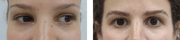 Transplantacija obrva? Pre i posle.