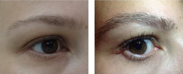 Transplantacija obrva? Pre i posle.