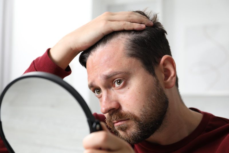 Transplantacija kose ko je pravi kandidat, a ko nije