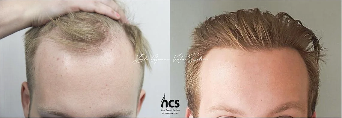 FUE transplantacija kose