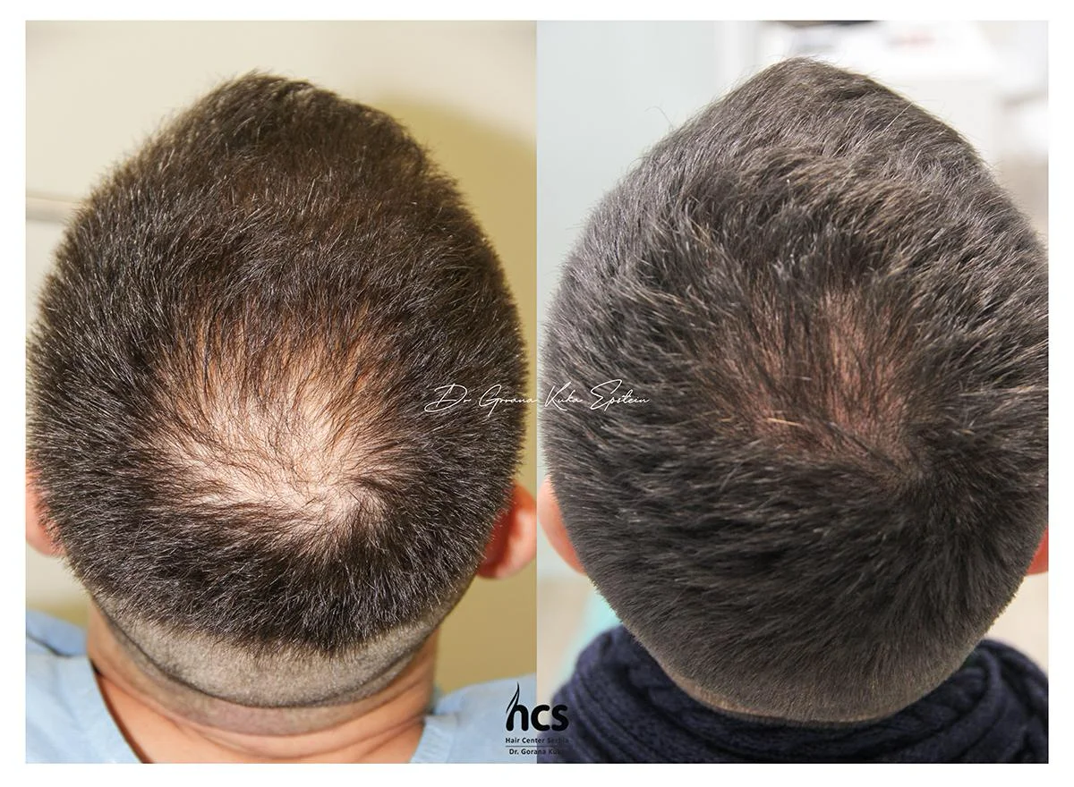FUE transplantacija kose