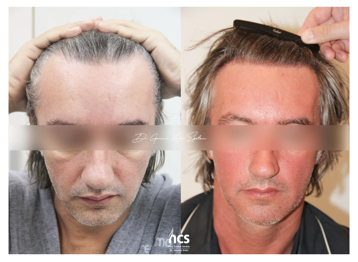 FUE transplantacija kose