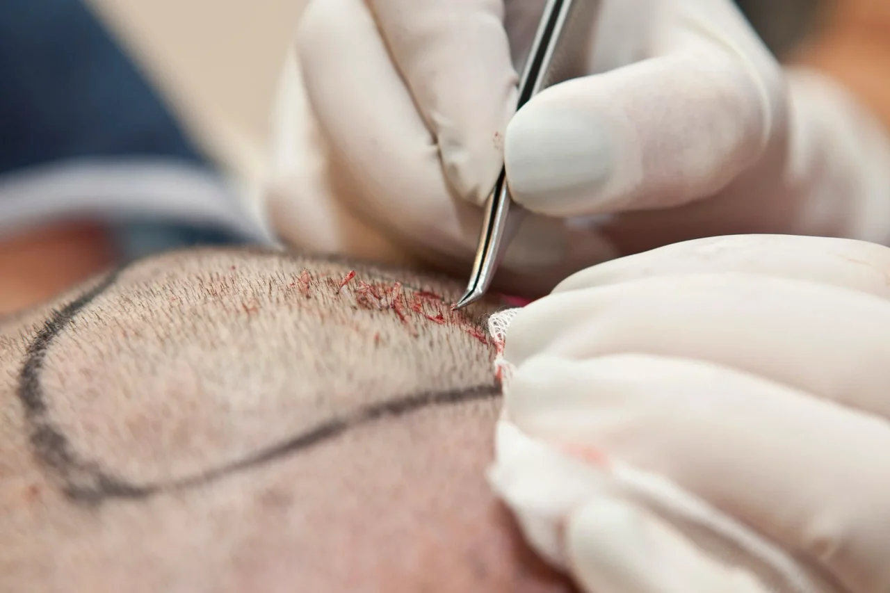 Sekundarna transplantacija kose